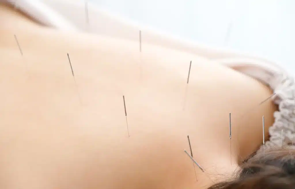 Acupuncture for chronic pain treatment